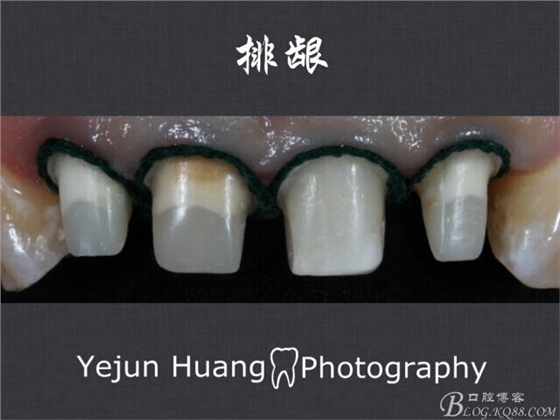 黃葉君：淺談口腔固定修復流程]第四期：后牙的預備流程