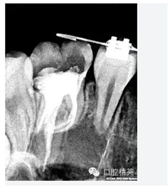 彎曲根管預備的方法和技巧