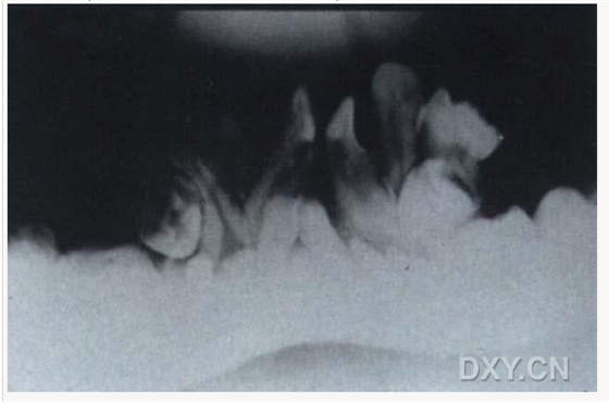 含牙囊腫 含牙囊腫