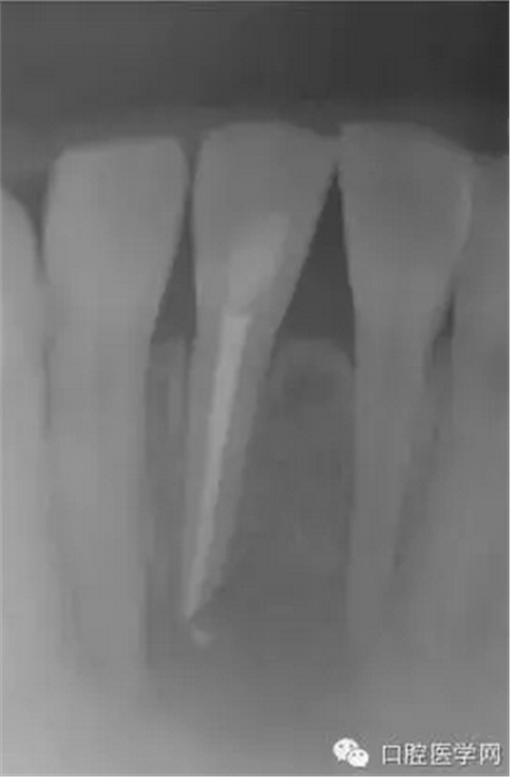 常規根管治療成功處理根尖周病變較大牙齒