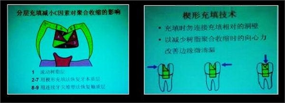 各類牙洞型樹脂修復