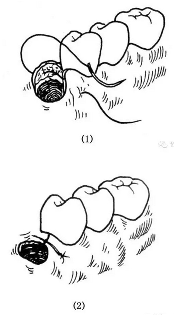 牙醫基本技能：口內縫合術（文字、示意圖及視頻）