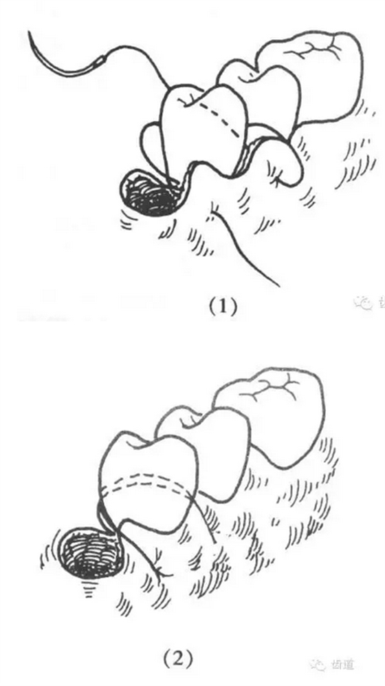 牙醫基本技能：口內縫合術（文字、示意圖及視頻）