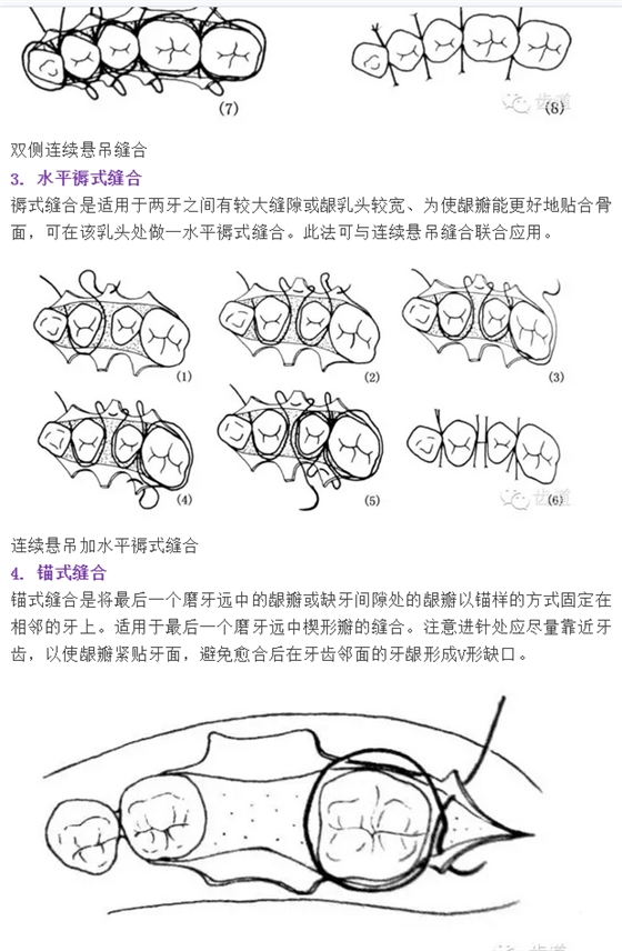 牙醫基本技能：口內縫合術（文字、示意圖及視頻）
