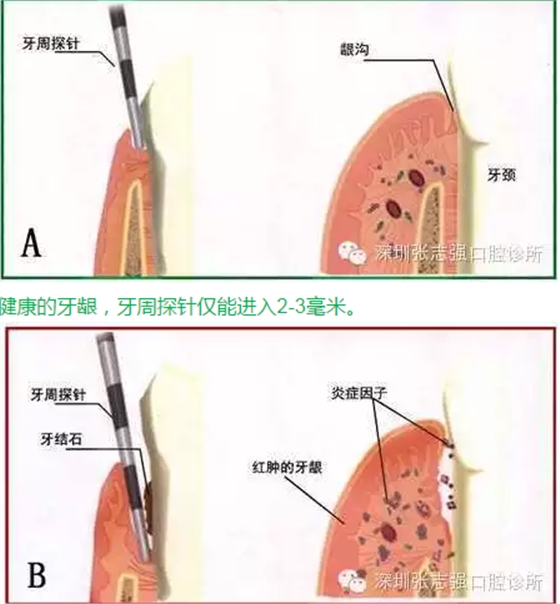 刷牙出血，牙齦紅腫，并非缺乏維生素