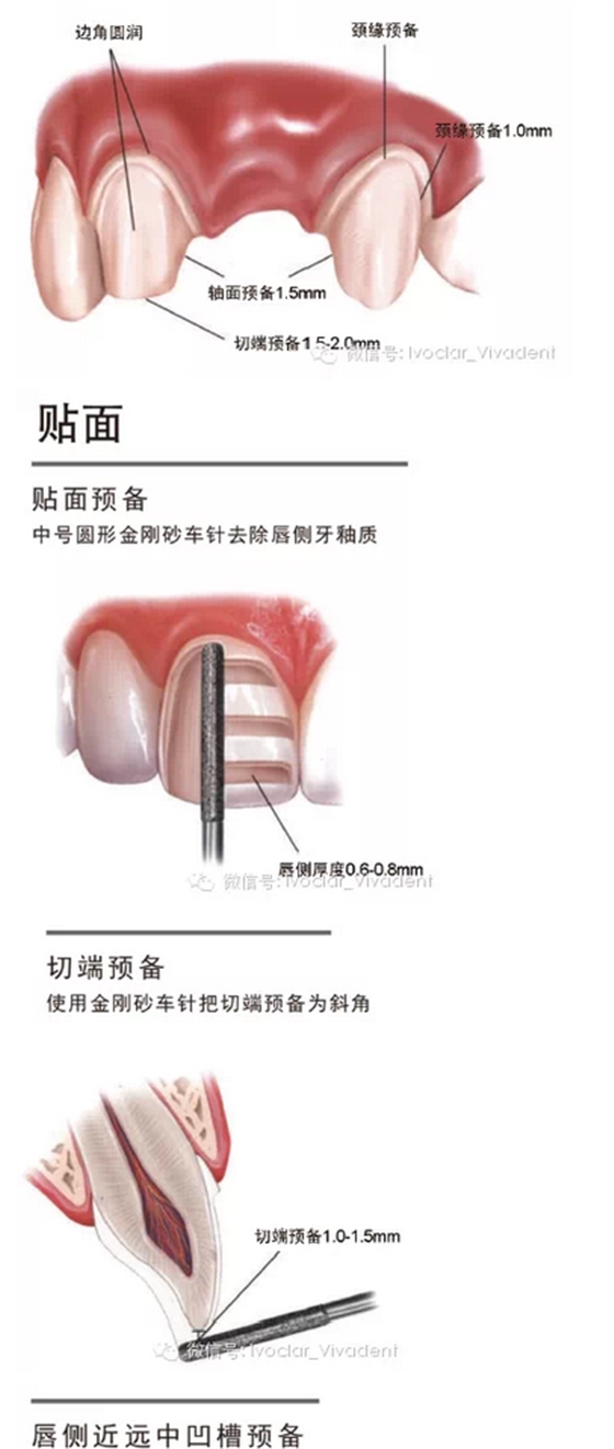 時常搞不清楚怎么備牙嗎？義獲嘉教您如何完美備牙
