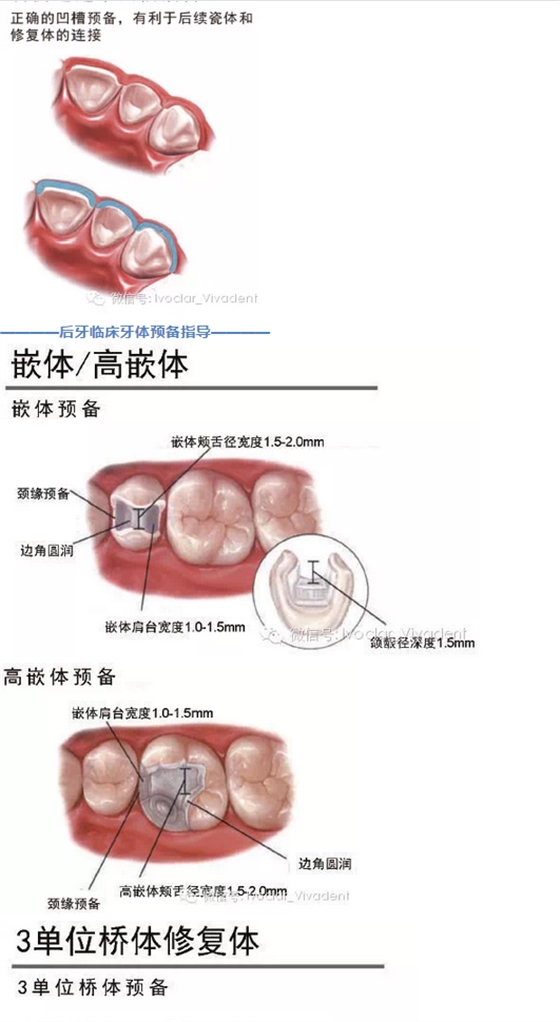 時常搞不清楚怎么備牙嗎？義獲嘉教您如何完美備牙