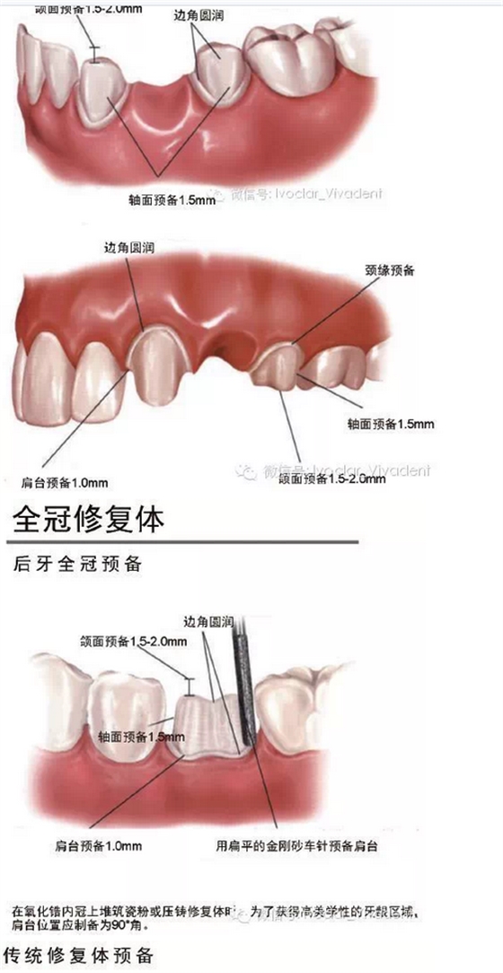 時常搞不清楚怎么備牙嗎？義獲嘉教您如何完美備牙