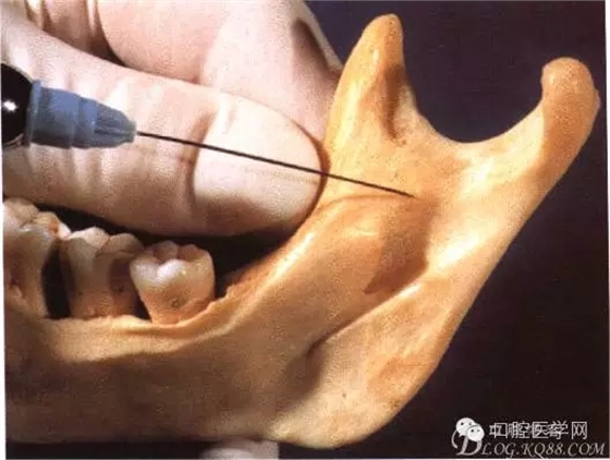 即使是老手也會失手的麻醉----下牙槽、舌、頰一次阻滯麻醉