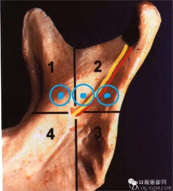 即使是老手也會失手的麻醉----下牙槽、舌、頰一次阻滯麻醉