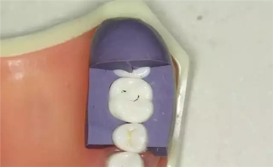 硅橡膠導板——牙體預備步驟詳解 硅橡膠導板——牙體預備步驟詳解