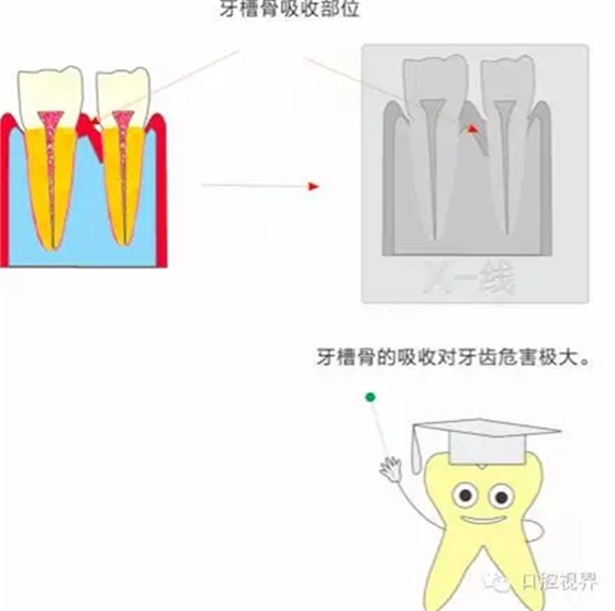 【愛牙科普知識300問】 “什么是牙齦萎縮？”