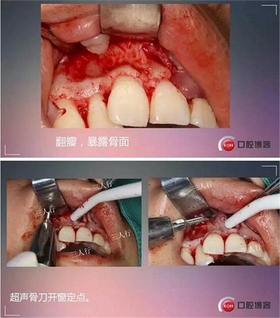 深部埋伏多生牙——微創處理  