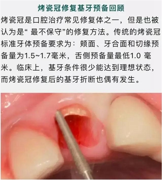 做全冠修復時基牙根面暴露，如何備牙？