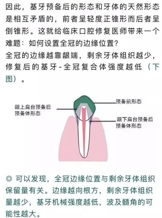 做全冠修復時基牙根面暴露，如何備牙？