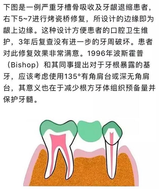 做全冠修復時基牙根面暴露，如何備牙？