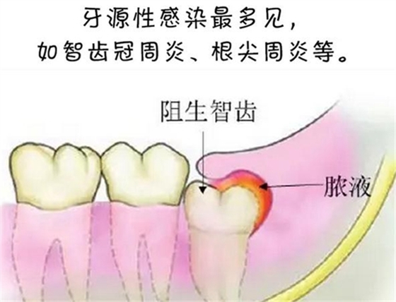 警惕！牙疼引發的間隙感染很危險