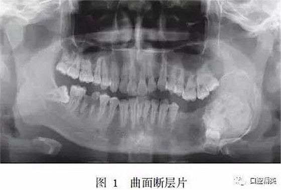 下頜骨骨化纖維瘤并發組合性牙瘤1例