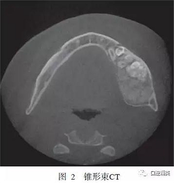 下頜骨骨化纖維瘤并發組合性牙瘤1例