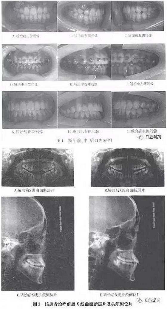 尖牙完全唇側錯位擁擠，矯正1例  