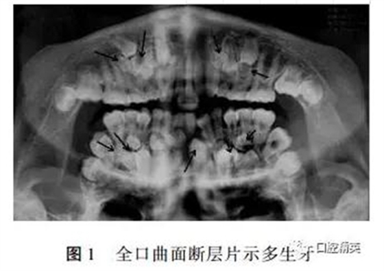 罕見多發性14顆多生牙1例