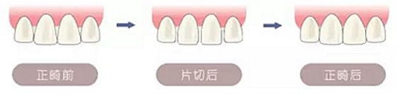 醫生方案里的鄰面去釉，究竟是什么？