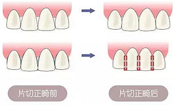 醫生方案里的鄰面去釉，究竟是什么？