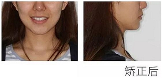 醫生方案里的鄰面去釉，究竟是什么？