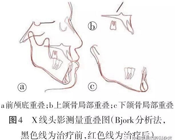 病例報(bào)告 | 上頜種植體支抗Ⅲ類牽引矯治骨性Ⅲ類反牙合伴開牙合1例報(bào)告