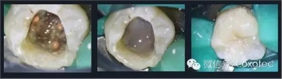 【現代根管治療】之熱牙膠充填技術