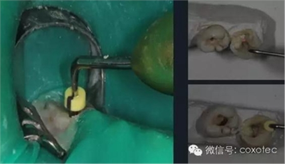 【現代根管治療】之熱牙膠充填技術