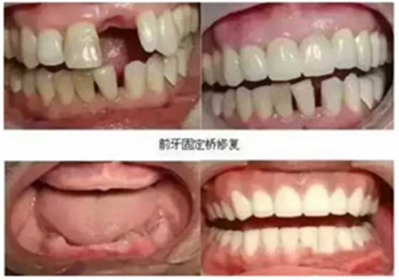 一位資深牙醫的總結 | 如何減輕患者鑲牙后酸痛癥狀的措施！