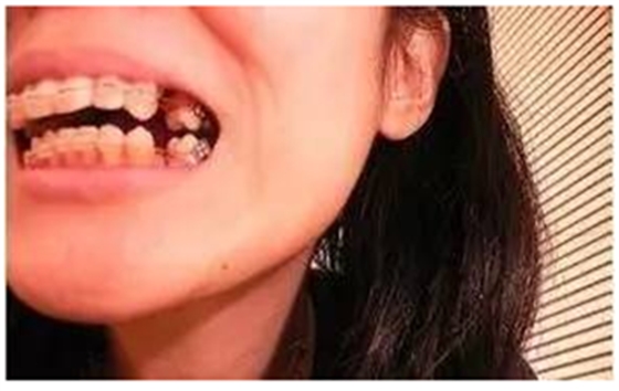 關(guān)于牙齒矯正，你想知道的都在這！