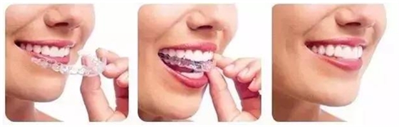 關(guān)于牙齒矯正，你想知道的都在這！