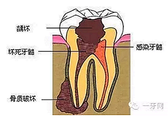詳解牙疼的原因分幾種？