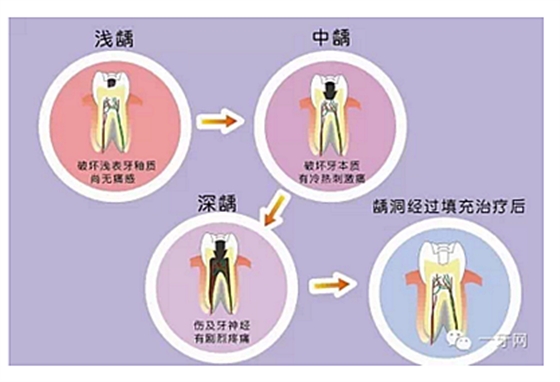 詳解牙疼的原因分幾種？