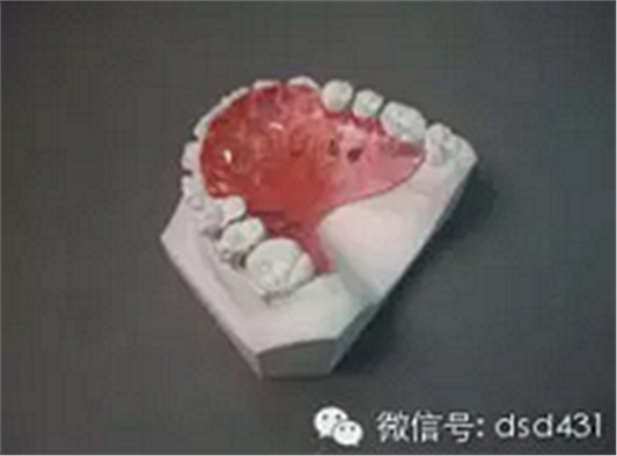 是什么導(dǎo)致了義齒返工？？？