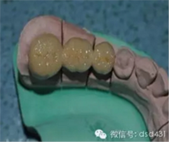是什么導(dǎo)致了義齒返工？？？