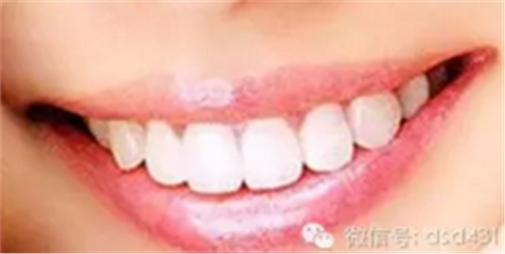 是什么導(dǎo)致了義齒返工？？？