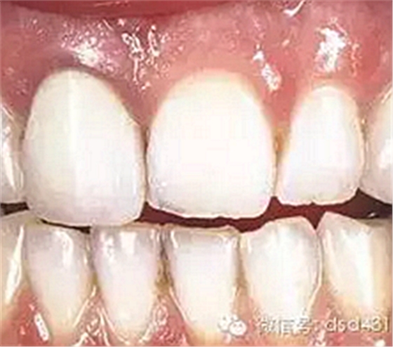 是什么導(dǎo)致了義齒返工？