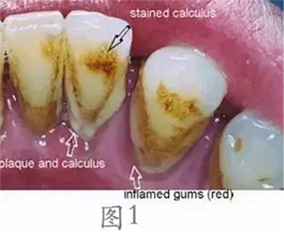 	 牙齦碰不得，一碰就出血。這是咋回事？