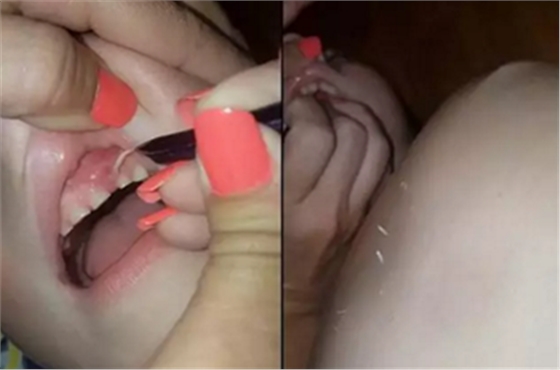 牙齦里拔出27片斷甲，是一種怎樣的體驗？