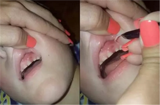 牙齦里拔出27片斷甲，是一種怎樣的體驗？