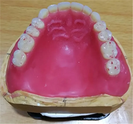 口腔患者的福音，卓逸精品工作室吸附性義齒案例鑒賞