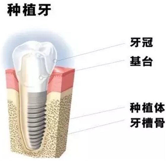 種植牙會(huì)松動(dòng)的原因是什么？