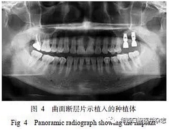 利用壓膜式活動矯治器壓入下頜第一、第二磨牙1例