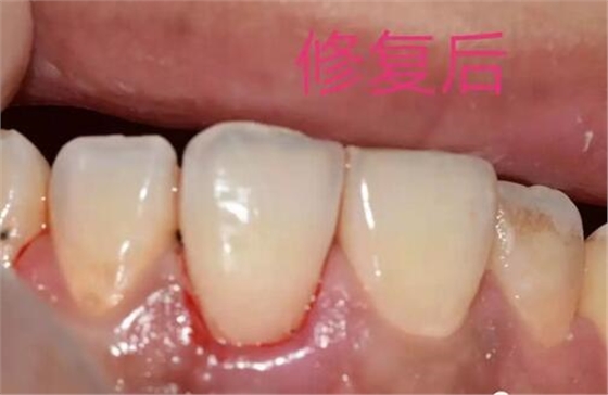 什么是牙齒楔缺？
