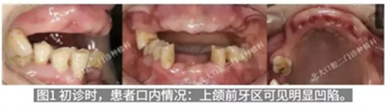病例報道│全程數(shù)字化輔助無牙頜種植即刻負重