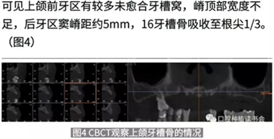 病例報道│全程數(shù)字化輔助無牙頜種植即刻負重