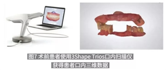 病例報道│全程數(shù)字化輔助無牙頜種植即刻負重